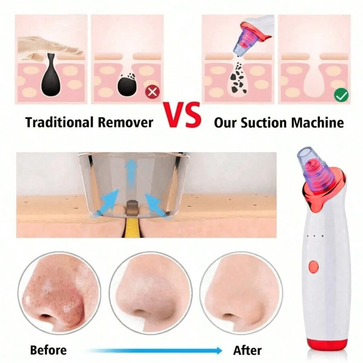 2026 Blackhead Remover Pimple Acne Removal Blackhead Vacuum Tool Skin Care Pore Cleaner Rechargeable